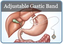 Adjustable Gastic Band Procedure Tucson