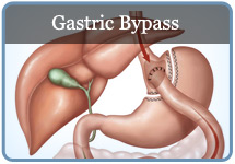 Gastric Bypass Tucson